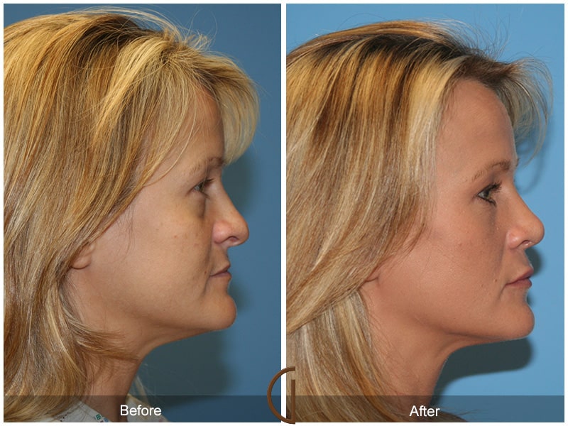 Rhinoplasty Nose Surgery Orange County CA 16 Image