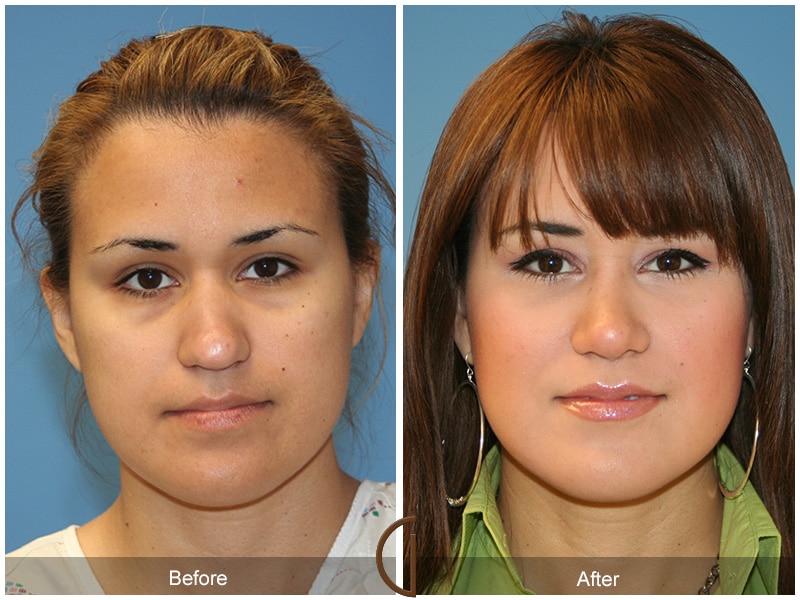 Rhinoplasty Nose Surgery Garden Grove CA 17 Image