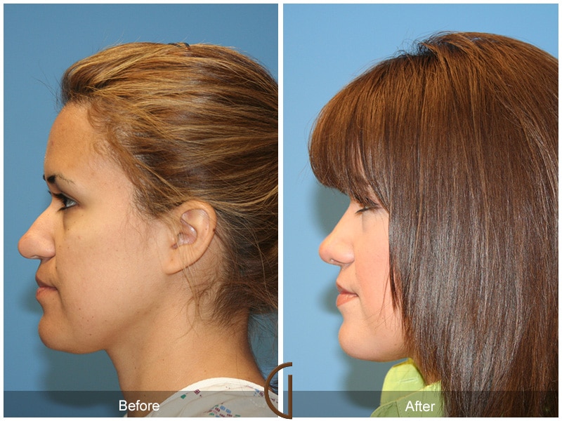 Rhinoplasty Nose Surgery Garden Grove CA 17 Image
