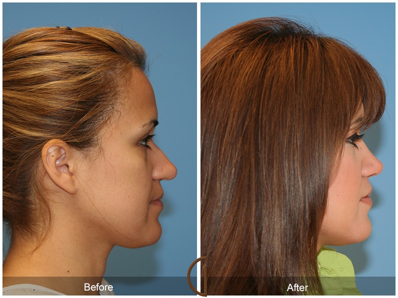 Rhinoplasty Nose Surgery Garden Grove CA 17 Image