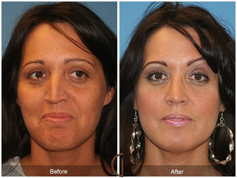 Rhinoplasty Nose Surgery Orange County CA 19 Image