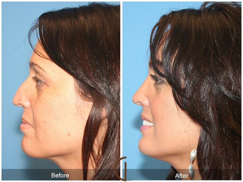 Rhinoplasty Nose Surgery Orange County CA 19 Image