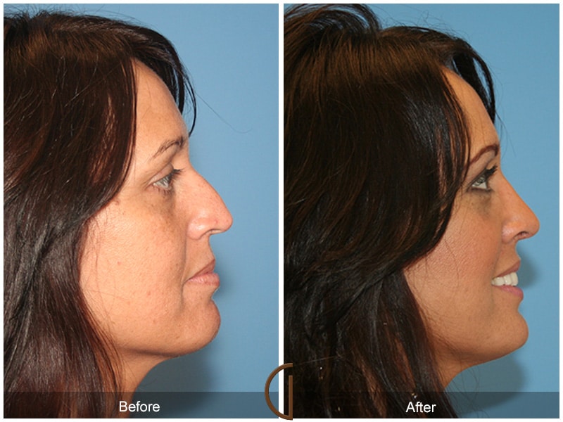 Rhinoplasty Nose Surgery Orange County CA 19 Image