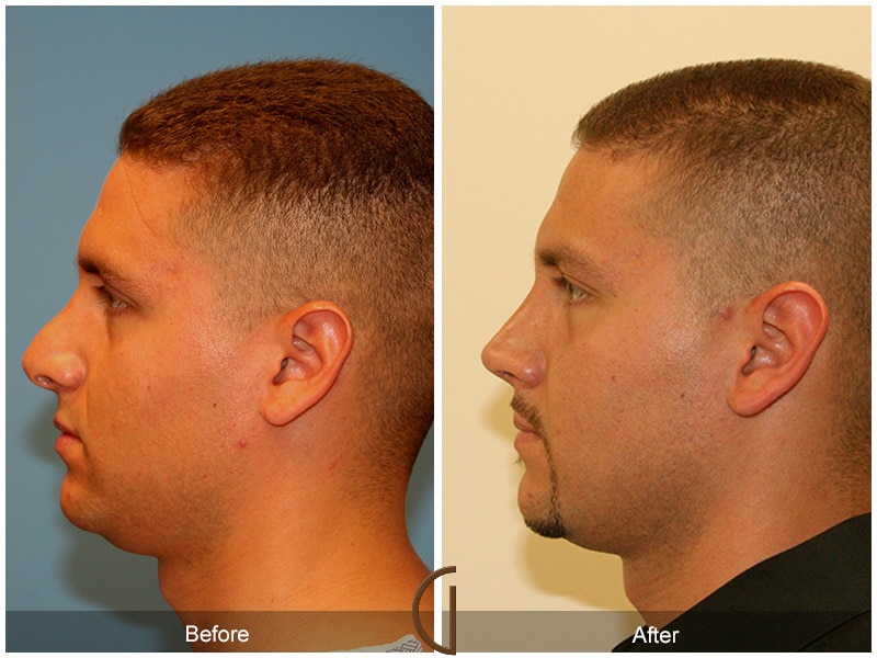 Rhinoplasty Nose Surgery Orange County CA 2 Image
