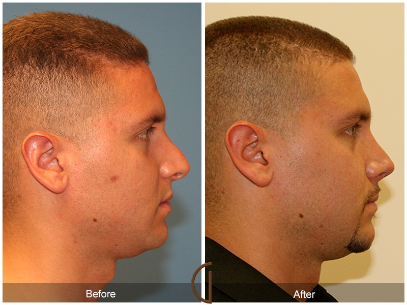 Rhinoplasty Nose Surgery Orange County CA 2 Image