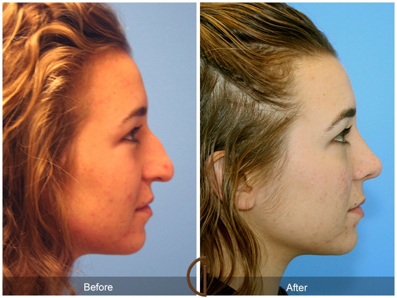 Rhinoplasty Nose Surgery Santa Ana CA 20 Image
