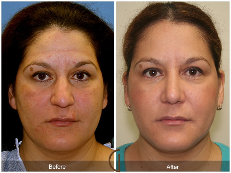 Rhinoplasty Nose Surgery Los Angeles CA 21 Image