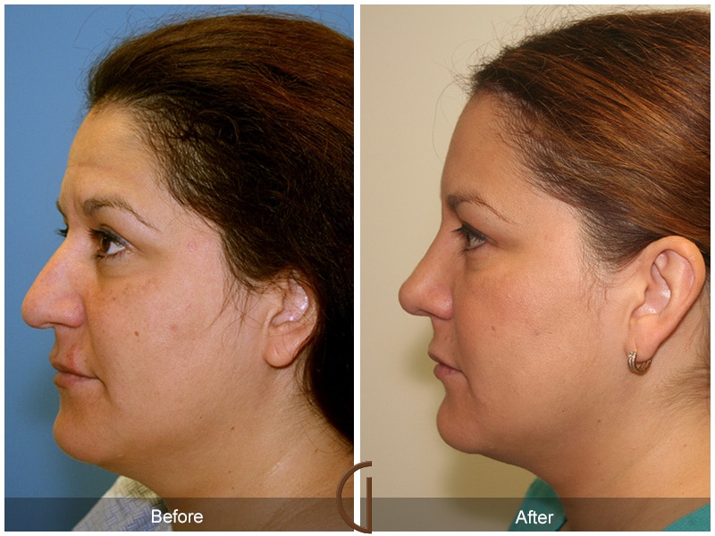 Rhinoplasty Nose Surgery Los Angeles CA 21 Image