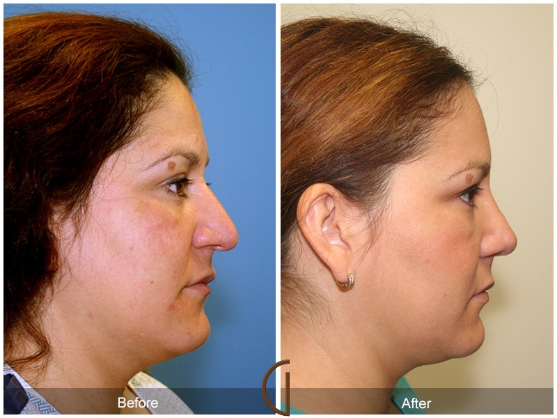Rhinoplasty Nose Surgery Los Angeles CA 21 Image