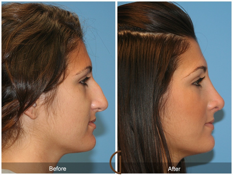 Rhinoplasty Nose Surgery Orange County CA 24 Image