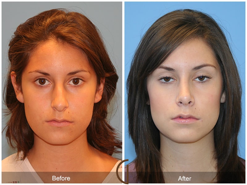 Before After Rhinoplasty 25 Image
