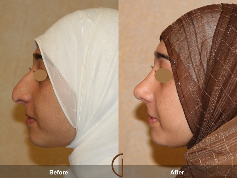 Rhinoplasty Nose Surgery Rolling Hills CA 26 Image