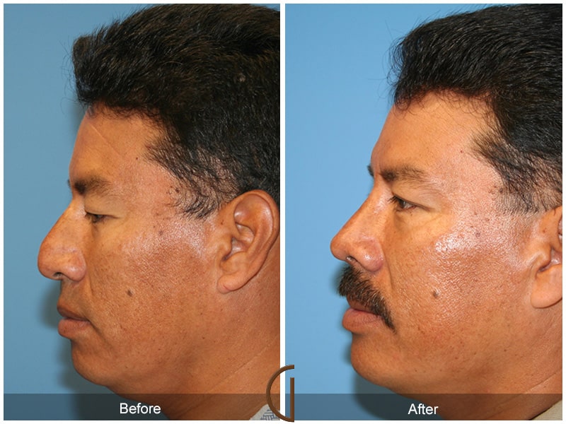 Rhinoplasty Nose Surgery Palos Verdes Estates CA 27 Image