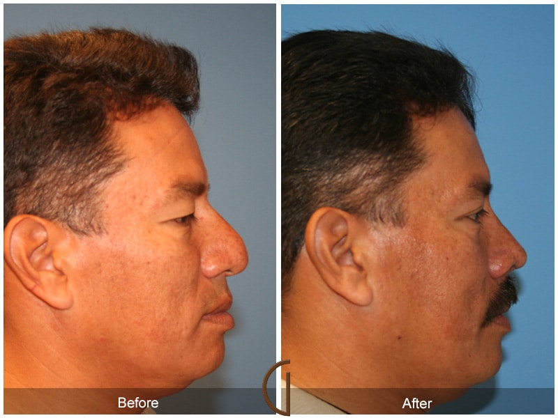 Rhinoplasty Nose Surgery Palos Verdes Estates CA 27 Image