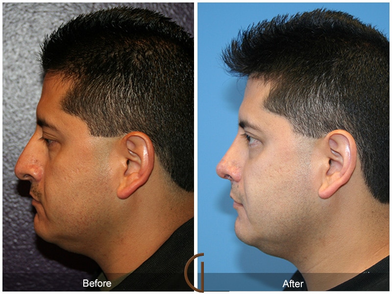 Rhinoplasty Nose Surgery Manhattan Beach CA 29 Image