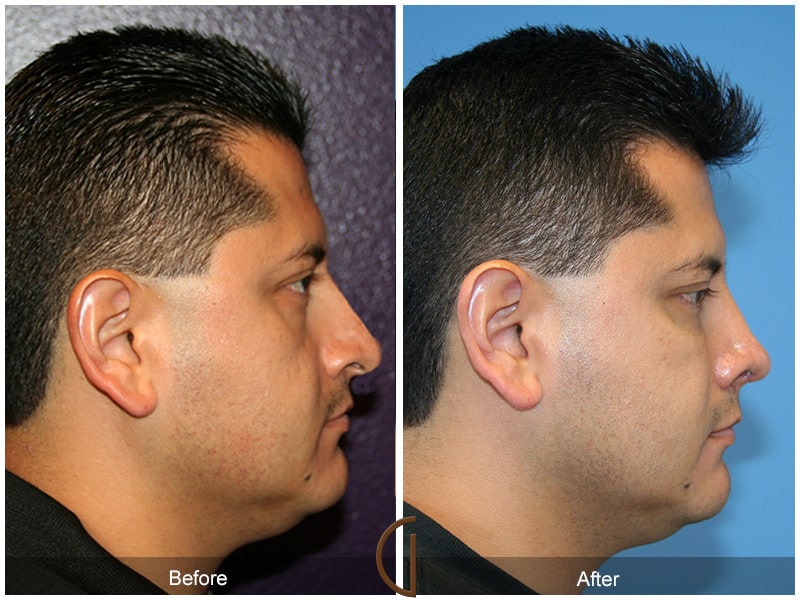 Rhinoplasty Nose Surgery Manhattan Beach CA 29 Image