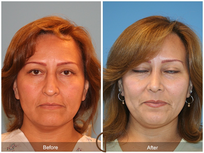 Rhinoplasty Nose Surgery Malibu CA 30 Image