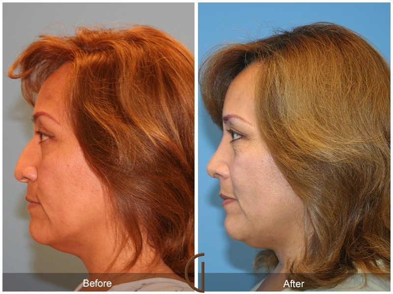 Rhinoplasty Nose Surgery Malibu CA 30 Image