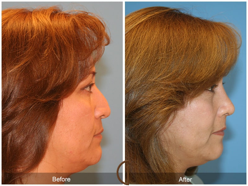 Rhinoplasty Nose Surgery Malibu CA 30 Image