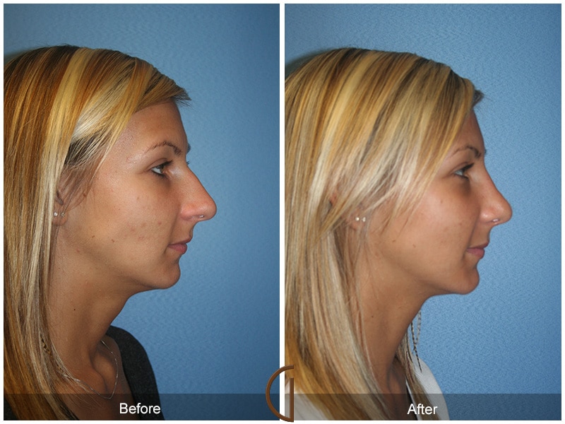 Rhinoplasty Nose Surgery Orange County CA 35 Image