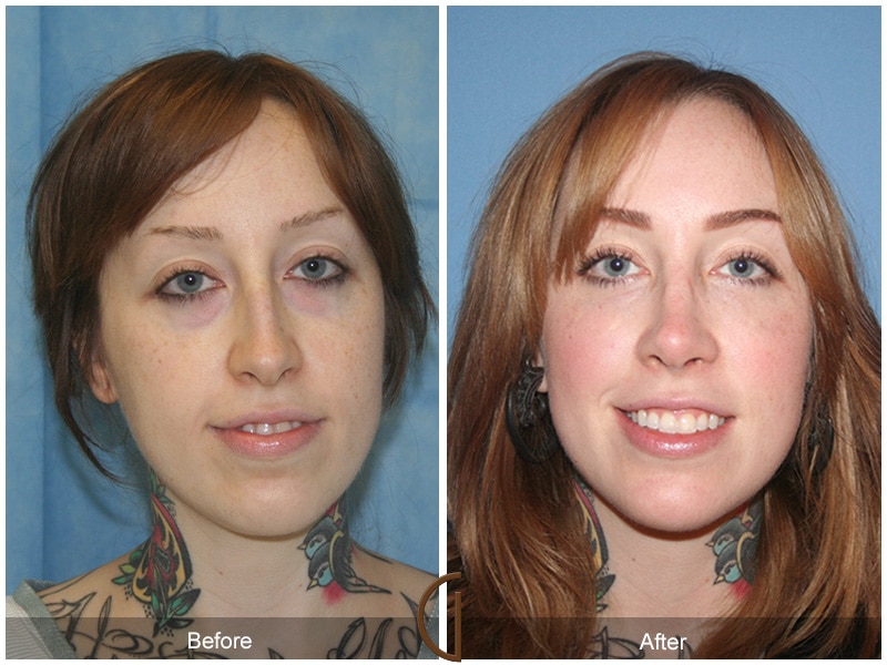 Rhinoplasty Nose Surgery Orange County CA 36 Image