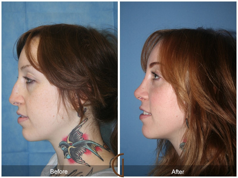 Rhinoplasty Nose Surgery Orange County CA 36 Image