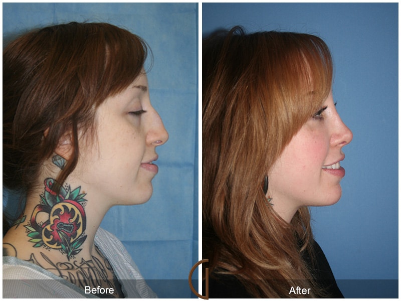 Rhinoplasty Nose Surgery Orange County CA 36 Image