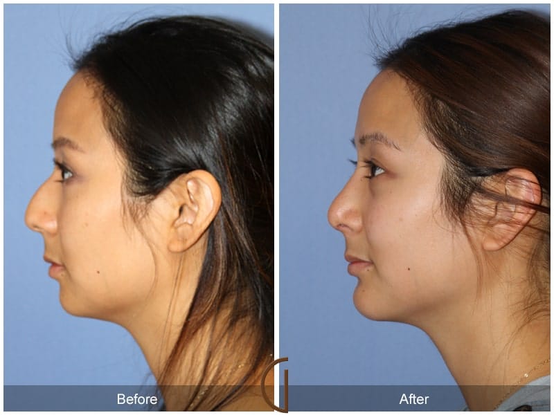 Rhinoplasty & Chin Villa Park CA 4 Image