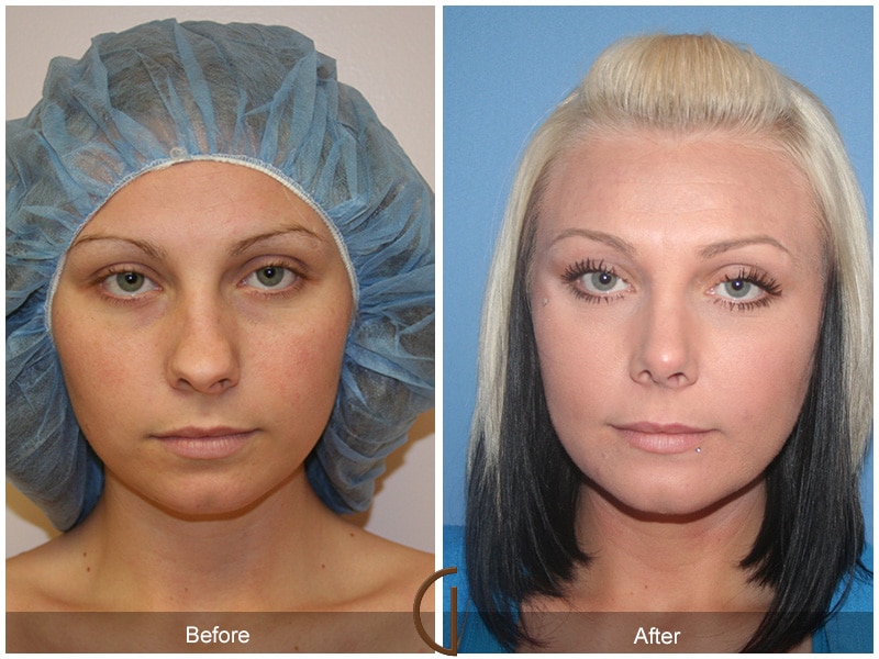 Rhinoplasty Nose Surgery Westlake Village CA 40 Image