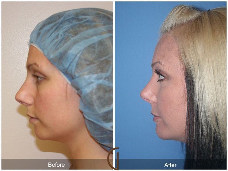 Rhinoplasty Nose Surgery Westlake Village CA 40 Image