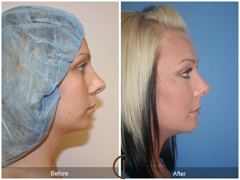 Rhinoplasty Nose Surgery Westlake Village CA 40 Image