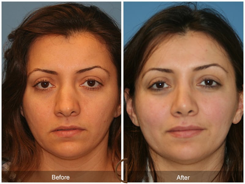 Ethnic Rhinoplasty Orange County 90 Image