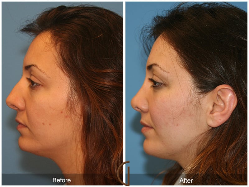 Ethnic Rhinoplasty Orange County 90 Image