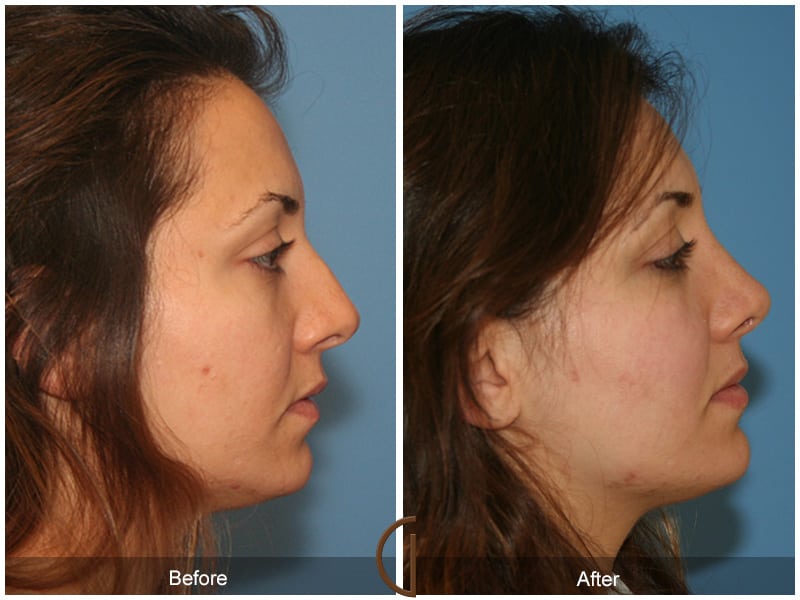 Ethnic Rhinoplasty Orange County 90 Image