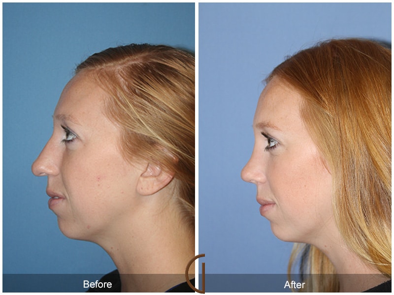Rhinoplasty Nose Surgery Eastvale CA 52 Image