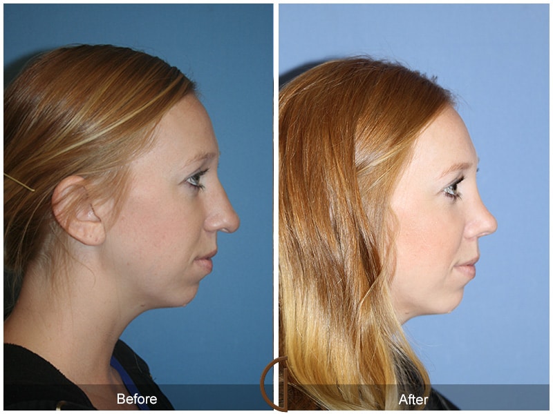 Rhinoplasty Nose Surgery Eastvale CA 52 Image