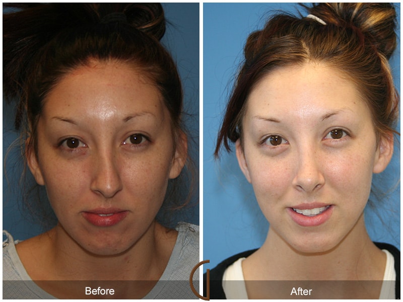 Rhinoplasty Nose Surgery Jamul CA 53 Image