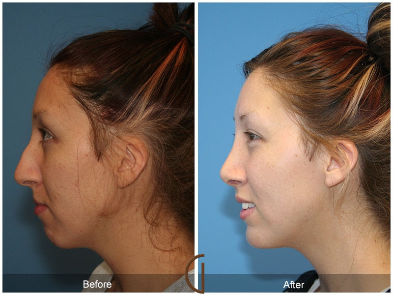 Rhinoplasty Nose Surgery Jamul CA 53 Image