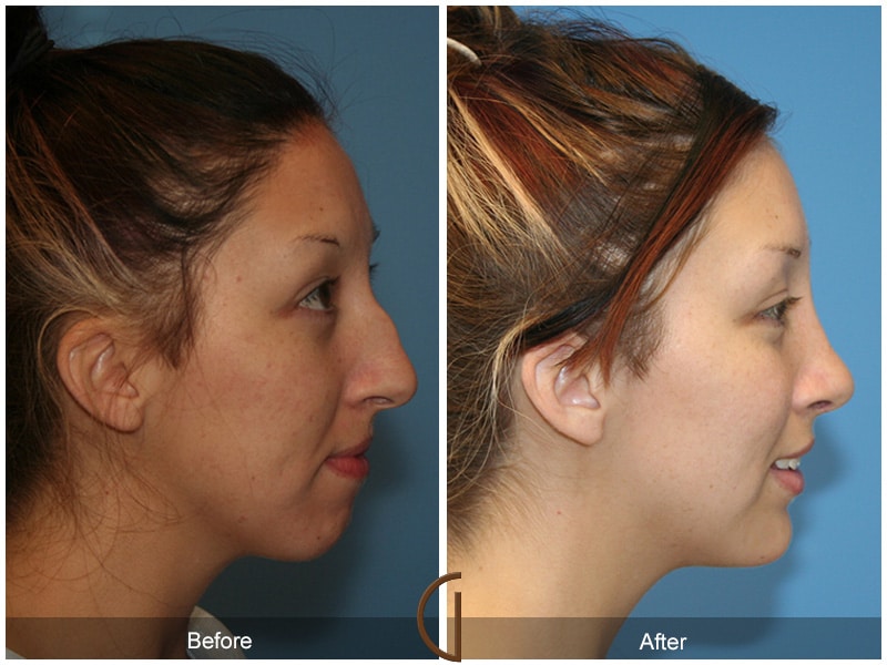 Rhinoplasty Nose Surgery Jamul CA 53 Image