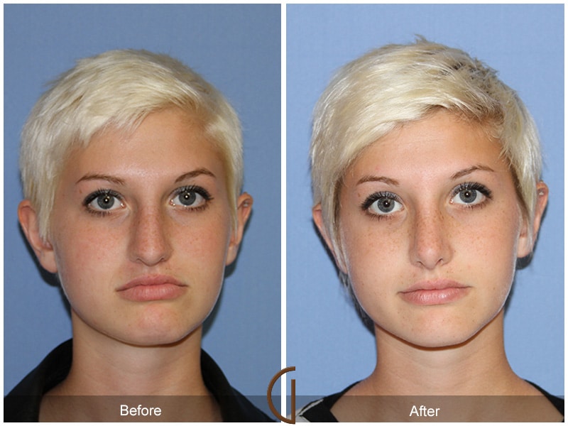 Rhinoplasty Nose Surgery Agoura Hills CA 54 Image