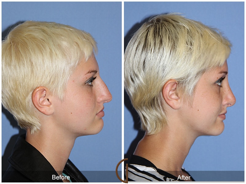 Rhinoplasty Nose Surgery Agoura Hills CA 54 Image