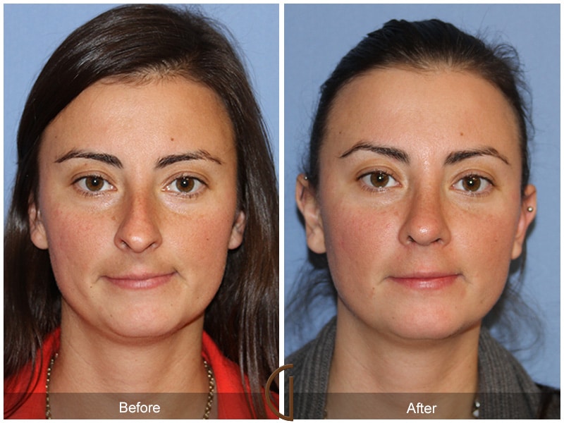 Rhinoplasty Nose Surgery Castaic CA 55 Image