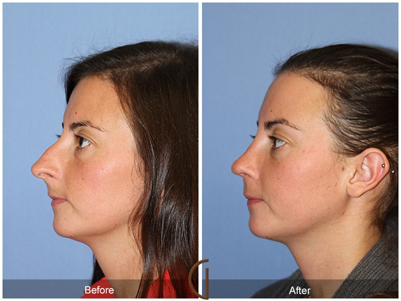 Rhinoplasty Nose Surgery Castaic CA 55 Image