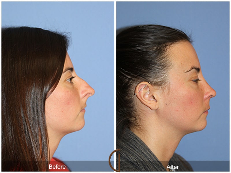 Rhinoplasty Nose Surgery Castaic CA 55 Image