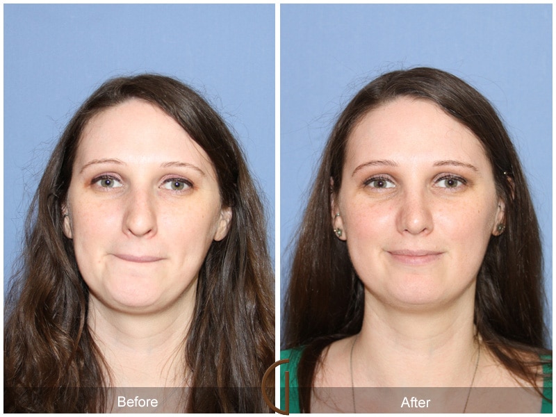 Rhinoplasty Nose Surgery Hermosa Beach CA 56 Image