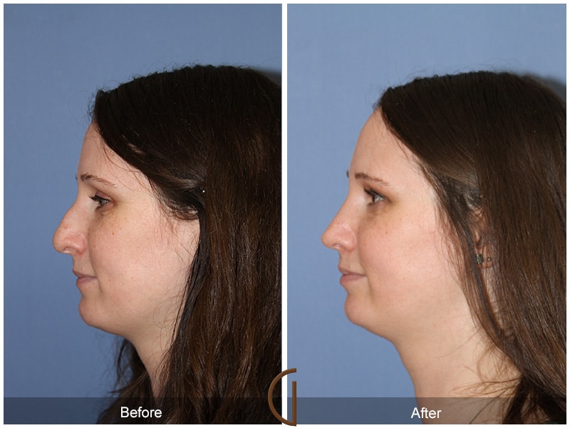 Rhinoplasty Nose Surgery Hermosa Beach CA 56 Image