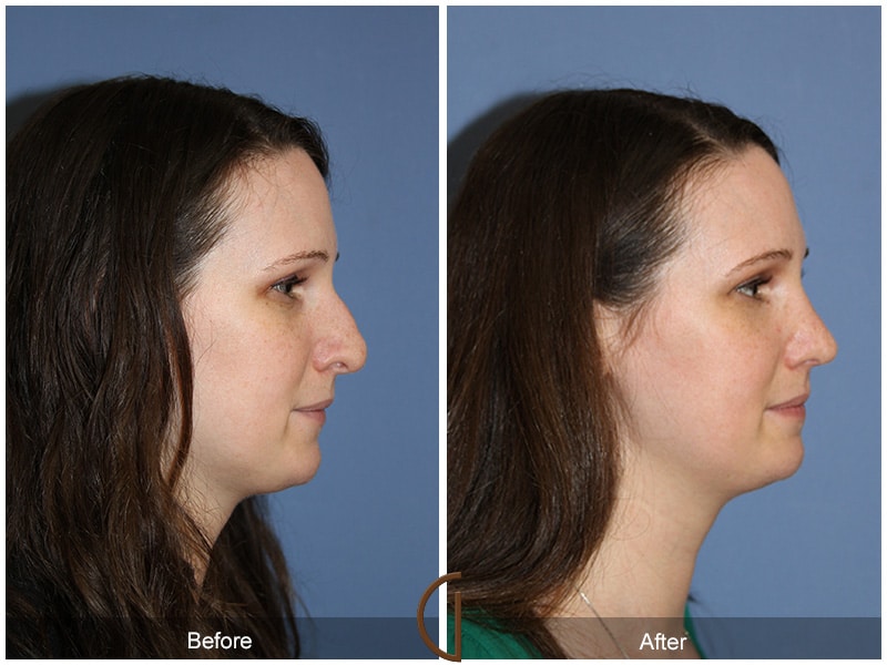 Rhinoplasty Nose Surgery Hermosa Beach CA 56 Image
