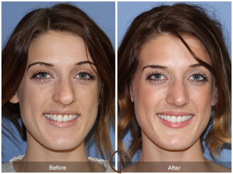 Rhinoplasty Nose Surgery Del Mar CA 57 Image