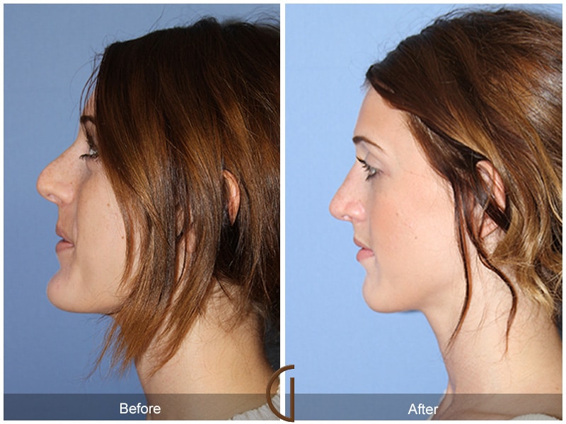 Rhinoplasty Nose Surgery Del Mar CA 57 Image