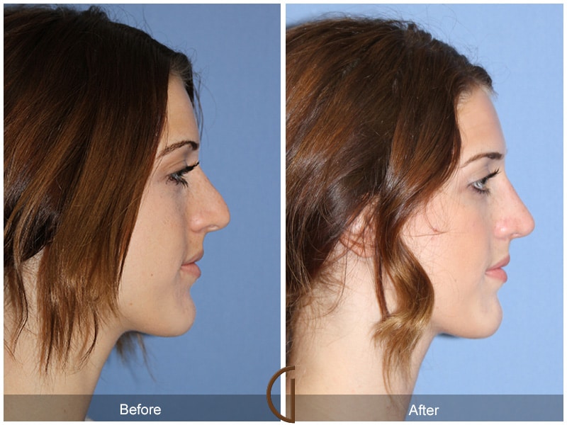 Rhinoplasty Nose Surgery Del Mar CA 57 Image